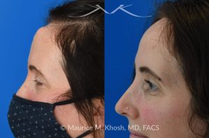 Photo of a patient before and after a procedure. Osteoma Removal - This 43 year old sought treatment for forehead osteoma in our New York office. She had the osteoma present for 20 years. The osteoma removal was performed in the office under local anesthesia. 

