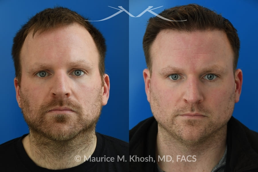 a before and after photo of a man after hair transplant