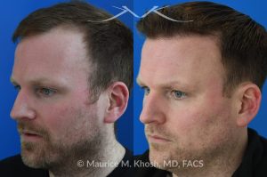 Photo of a patient before and after a procedure. A follicular extraction transplant (FUE) procedure  - This 36 year old man requested hair restoration for receding hairline.  A follicular extraction transplant (FUE) procedure allowed transplantation of 1800 follicles from the back of the head to the frontal and temporal region of the scalp. The photo shows his one year post transplant results. He is ecstatic with his results.