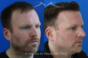 Photo of a patient before and after a procedure. A follicular extraction transplant (FUE) procedure  - This 36 year old man requested hair restoration for receding hairline.  A follicular extraction transplant (FUE) procedure allowed transplantation of 1800 follicles from the back of the head to the frontal and temporal region of the scalp. The photo shows his one year post transplant results. He is ecstatic with his results.