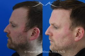 Photo of a patient before and after a procedure. A follicular extraction transplant (FUE) procedure  - This 36 year old man requested hair restoration for receding hairline.  A follicular extraction transplant (FUE) procedure allowed transplantation of 1800 follicles from the back of the head to the frontal and temporal region of the scalp. The photo shows his one year post transplant results. He is ecstatic with his results.