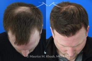 Photo of a patient before and after a procedure. A follicular extraction transplant (FUE) procedure  - This 36 year old man requested hair restoration for receding hairline.  A follicular extraction transplant (FUE) procedure allowed transplantation of 1800 follicles from the back of the head to the frontal and temporal region of the scalp. The photo shows his one year post transplant results. He is ecstatic with his results.