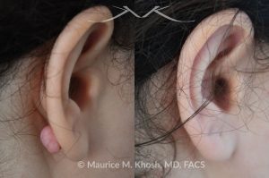 Photo of a patient before and after a procedure. Keloid scar on back of right earlobe
