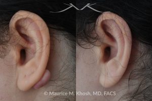 Photo of a patient before and after a procedure. Keloid scar on back of right earlobe