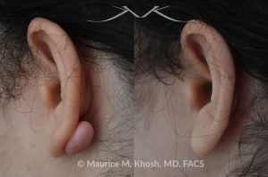 Photo of a patient before and after a procedure. Keloid scar on back of right earlobe