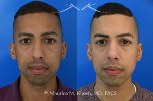Photo of a patient before and after a procedure. Rhinoplasty for tip and nostril asymmtery, and nasal hump