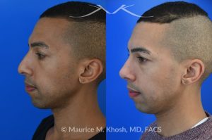 Photo of a patient before and after a procedure. Rhinoplasty for tip and nostril asymmtery, and nasal hump