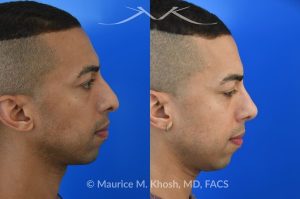 Photo of a patient before and after a procedure. Rhinoplasty for tip and nostril asymmtery, and nasal hump