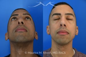 Photo of a patient before and after a procedure. Rhinoplasty for tip and nostril asymmtery, and nasal hump