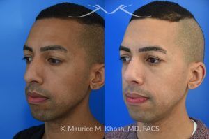 Photo of a patient before and after a procedure. Rhinoplasty for tip and nostril asymmtery, and nasal hump