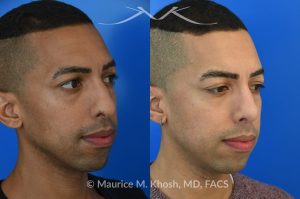 Photo of a patient before and after a procedure. Rhinoplasty for tip and nostril asymmtery, and nasal hump