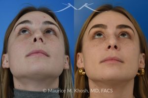 Photo of a patient before and after a procedure. Rhinoplasty to straighten the tip and reduce nasal hump