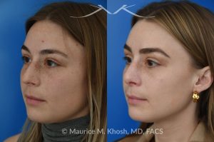 Photo of a patient before and after a procedure. Rhinoplasty to straighten the tip and reduce nasal hump