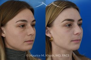 Photo of a patient before and after a procedure. Rhinoplasty to straighten the tip and reduce nasal hump