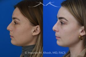 Photo of a patient before and after a procedure. Rhinoplasty to straighten the tip and reduce nasal hump - Patient sought septoplasty and rhinoplasty in our Manhattan office to address chronic nasal obstruction, deviated appearing bridge, a small dorsal hump, and sagging nasal tip. Surgery was performed through a closed approach (endo-nasal approach). The results show the one year result. She is ecstatic with the breathing and aesthetic results.