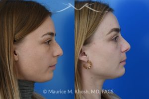 Photo of a patient before and after a procedure. Rhinoplasty to straighten the tip and reduce nasal hump