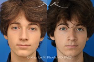 Photo of a patient before and after a procedure. Nose hump removal - This 18 year old sought rhinoplasty consultation in our Manhattan office, to remove a hump from the bridge of his nose. Rhinoplasty was performed through a closed approach to straighten the profile. 