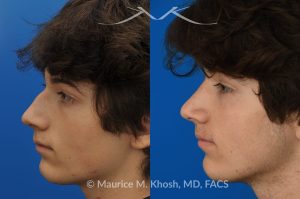 Photo of a patient before and after a procedure. Nose hump removal - This 18 year old sought rhinoplasty consultation in our Manhattan office, to remove a hump from the bridge of his nose. Rhinoplasty was performed through a closed approach to straighten the profile. 