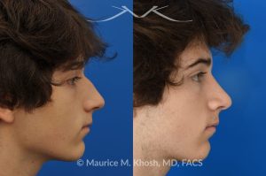 Photo of a patient before and after a procedure. Nose hump removal - This 18 year old sought rhinoplasty consultation in our Manhattan office, to remove a hump from the bridge of his nose. Rhinoplasty was performed through a closed approach to straighten the profile. 