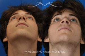 Photo of a patient before and after a procedure. Nose hump removal - This 18 year old sought rhinoplasty consultation in our Manhattan office, to remove a hump from the bridge of his nose. Rhinoplasty was performed through a closed approach to straighten the profile. 