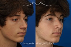 Photo of a patient before and after a procedure. Nose hump removal - This 18 year old sought rhinoplasty consultation in our Manhattan office, to remove a hump from the bridge of his nose. Rhinoplasty was performed through a closed approach to straighten the profile. 