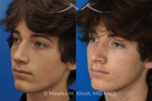 Photo of a patient before and after a procedure. Nose hump removal - This 18 year old sought rhinoplasty consultation in our Manhattan office, to remove a hump from the bridge of his nose. Rhinoplasty was performed through a closed approach to straighten the profile. 