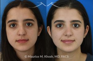 Photo of a patient before and after a procedure. Rhinoplasty to eliminate dorsal hump and refine nasal tip - This 18 year-old was interested in rhinoplasty in New York to eliminate her nasal hump, narrow and refine the tip, and address deviated septum which caused breathing obstruction and asymmetric nostrils. An open approach rhinoplasty was used to address all her concerns. 