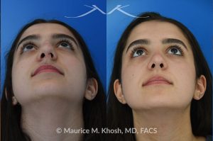 Photo of a patient before and after a procedure. Rhinoplasty to eliminate dorsal hump and refine nasal tip - This 18 year-old was interested in rhinoplasty in New York to eliminate her nasal hump, narrow and refine the tip, and address deviated septum which caused breathing obstruction and asymmetric nostrils. An open approach rhinoplasty was used to address all her concerns. 