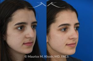 Photo of a patient before and after a procedure. Rhinoplasty to eliminate dorsal hump and refine nasal tip - This 18 year-old was interested in rhinoplasty in New York to eliminate her nasal hump, narrow and refine the tip, and address deviated septum which caused breathing obstruction and asymmetric nostrils. An open approach rhinoplasty was used to address all her concerns. 
