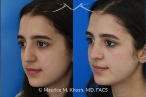 Photo of a patient before and after a procedure. Rhinoplasty to eliminate dorsal hump and refine nasal tip - This 18 year-old was interested in rhinoplasty in New York to eliminate her nasal hump, narrow and refine the tip, and address deviated septum which caused breathing obstruction and asymmetric nostrils. An open approach rhinoplasty was used to address all her concerns. 