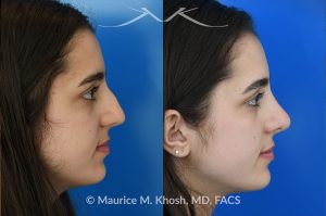 Photo of a patient before and after a procedure. Rhinoplasty to eliminate dorsal hump and refine nasal tip - This 18 year-old was interested in rhinoplasty in New York to eliminate her nasal hump, narrow and refine the tip, and address deviated septum which caused breathing obstruction and asymmetric nostrils. An open approach rhinoplasty was used to address all her concerns. 