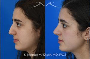 Photo of a patient before and after a procedure. Rhinoplasty to eliminate dorsal hump and refine nasal tip - This 18 year-old was interested in rhinoplasty in New York to eliminate her nasal hump, narrow and refine the tip, and address deviated septum which caused breathing obstruction and asymmetric nostrils. An open approach rhinoplasty was used to address all her concerns. 