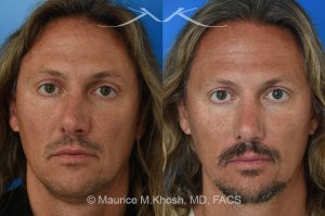 Photo of a patient before and after a procedure. Rhinoplasty for crooked nose - This 44 year old had suffered multiple nose fractures as a young adult. He complained of complete nasal obstruction due a severely deviated septum, and an extremely crooked nose. He was treated through an open rhinoplasty approach. Cadaver rib cartilage was used to straighten his severely deviated septum. Additional cartilage grafts to the bridge of the nose and the left alar region allowed the correction of his functional and cosmetic concerns. He is ecstatic with his results. 