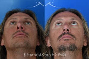 Photo of a patient before and after a procedure. Rhinoplasty for crooked nose - This 44 year old had suffered multiple nose fractures as a young adult. He complained of complete nasal obstruction due a severely deviated septum, and an extremely crooked nose. He was treated through an open rhinoplasty approach. Cadaver rib cartilage was used to straighten his severely deviated septum. Additional cartilage grafts to the bridge of the nose and the left alar region allowed the correction of his functional and cosmetic concerns. He is ecstatic with his results. 