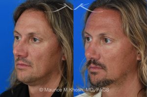 Photo of a patient before and after a procedure. Rhinoplasty for crooked nose - This 44 year old had suffered multiple nose fractures as a young adult. He complained of complete nasal obstruction due a severely deviated septum, and an extremely crooked nose. He was treated through an open rhinoplasty approach. Cadaver rib cartilage was used to straighten his severely deviated septum. Additional cartilage grafts to the bridge of the nose and the left alar region allowed the correction of his functional and cosmetic concerns. He is ecstatic with his results. 