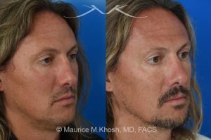 Photo of a patient before and after a procedure. Rhinoplasty for crooked nose - This 44 year old had suffered multiple nose fractures as a young adult. He complained of complete nasal obstruction due a severely deviated septum, and an extremely crooked nose. He was treated through an open rhinoplasty approach. Cadaver rib cartilage was used to straighten his severely deviated septum. Additional cartilage grafts to the bridge of the nose and the left alar region allowed the correction of his functional and cosmetic concerns. He is ecstatic with his results. 