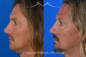 Photo of a patient before and after a procedure. Rhinoplasty for crooked nose - This 44 year old had suffered multiple nose fractures as a young adult. He complained of complete nasal obstruction due a severely deviated septum, and an extremely crooked nose. He was treated through an open rhinoplasty approach. Cadaver rib cartilage was used to straighten his severely deviated septum. Additional cartilage grafts to the bridge of the nose and the left alar region allowed the correction of his functional and cosmetic concerns. He is ecstatic with his results. 