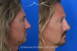 Photo of a patient before and after a procedure. Rhinoplasty for crooked nose - This 44 year old had suffered multiple nose fractures as a young adult. He complained of complete nasal obstruction due a severely deviated septum, and an extremely crooked nose. He was treated through an open rhinoplasty approach. Cadaver rib cartilage was used to straighten his severely deviated septum. Additional cartilage grafts to the bridge of the nose and the left alar region allowed the correction of his functional and cosmetic concerns. He is ecstatic with his results. 