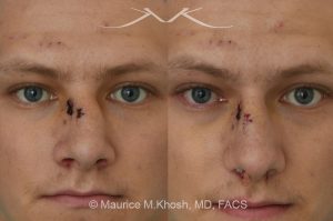 Photo of a patient before and after a procedure. Nose fracture - This 22 year old suffered a broken nose after a fall due to a bike accident. The nasal fracture was repaired in the office, under local anesthesia. 