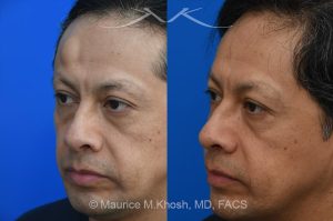 Photo of a patient before and after a procedure. Lipoma - The lipoma in this picture had been enlarging over a number of years. The patient wished to avoid a visible scar in the forehead. We utilized an endoscopic approach within the hairline to remove this large lipoma. The forehead is now perfectly smooth and there is NO visible scar from the endoscopic approach. 