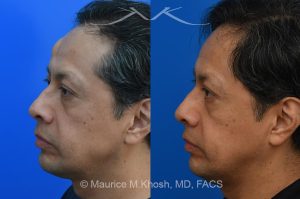 Photo of a patient before and after a procedure. Lipoma - The lipoma in this picture had been enlarging over a number of years. The patient wished to avoid a visible scar in the forehead. We utilized an endoscopic approach within the hairline to remove this large lipoma. The forehead is now perfectly smooth and there is NO visible scar from the endoscopic approach. 