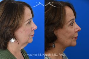 Photo of a patient before and after a procedure. Facelift, neck lift - This is a 75 year-old who wanted to get rid of her neck waddle. She did not wish to have a full facelift operation as she was only concerned about the neck. A deep-plane neck lift was performed through a perfectly hidden incision under the chin. Excess fat was removed and the neck muscles were tightened. There are no incisions round the ears. The patient never took any pain medication. She is ecstatic with her results.