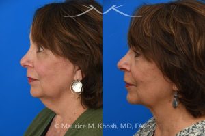 Photo of a patient before and after a procedure. Facelift, neck lift - This is a 75 year-old who wanted to get rid of her neck waddle. She did not wish to have a full facelift operation as she was only concerned about the neck. A deep-plane neck lift was performed through a perfectly hidden incision under the chin. Excess fat was removed and the neck muscles were tightened. There are no incisions round the ears. The patient never took any pain medication. She is ecstatic with her results.