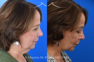 Photo of a patient before and after a procedure. Facelift, neck lift - This is a 75 year-old who wanted to get rid of her neck waddle. She did not wish to have a full facelift operation as she was only concerned about the neck. A deep-plane neck lift was performed through a perfectly hidden incision under the chin. Excess fat was removed and the neck muscles were tightened. There are no incisions round the ears. The patient never took any pain medication. She is ecstatic with her results.