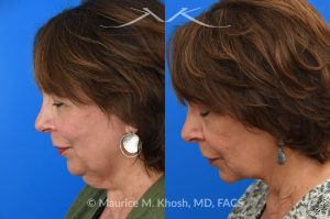 Photo of a patient before and after a procedure. Facelift, neck lift - This is a 75 year-old who wanted to get rid of her neck waddle. She did not wish to have a full facelift operation as she was only concerned about the neck. A deep-plane neck lift was performed through a perfectly hidden incision under the chin. Excess fat was removed and the neck muscles were tightened. There are no incisions round the ears. The patient never took any pain medication. She is ecstatic with her results.