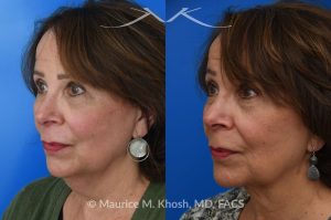 Photo of a patient before and after a procedure. Facelift, neck lift - This is a 75 year-old who wanted to get rid of her neck waddle. She did not wish to have a full facelift operation as she was only concerned about the neck. A deep-plane neck lift was performed through a perfectly hidden incision under the chin. Excess fat was removed and the neck muscles were tightened. There are no incisions round the ears. The patient never took any pain medication. She is ecstatic with her results.