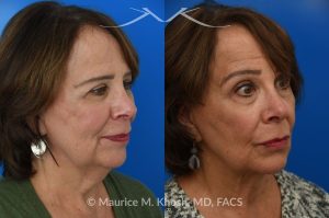 Photo of a patient before and after a procedure. Facelift, neck lift - This is a 75 year-old who wanted to get rid of her neck waddle. She did not wish to have a full facelift operation as she was only concerned about the neck. A deep-plane neck lift was performed through a perfectly hidden incision under the chin. Excess fat was removed and the neck muscles were tightened. There are no incisions round the ears. The patient never took any pain medication. She is ecstatic with her results.