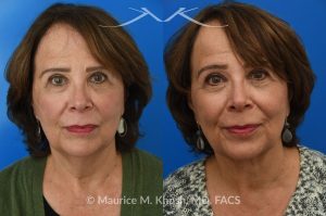 Photo of a patient before and after a procedure. Facelift, neck lift - This is a 75 year-old who wanted to get rid of her neck waddle. She did not wish to have a full facelift operation as she was only concerned about the neck. A deep-plane neck lift was performed through a perfectly hidden incision under the chin. Excess fat was removed and the neck muscles were tightened. There are no incisions round the ears. The patient never took any pain medication. She is ecstatic with her results.