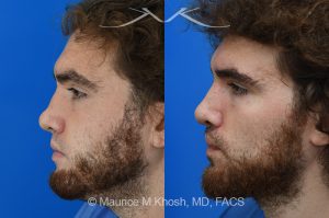 Photo of a patient before and after a procedure. Revision rhinoplasty with ear cartilage graft and osteotomies - This 26 year-old had previously undergone rhinoplasty which resulted in over-resection of the nasal bridge and excess width of the bony nasal dorsum. He underwent revision rhinoplasty in Manhattan by us. Ear cartilage was used to augment the height of the nasal bridge. The nasal bones were broken and moved closer to each other, to narrow the bridge. He is ecstatic with his revision rhinoplasty results. 