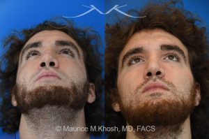 Photo of a patient before and after a procedure. Revision rhinoplasty with ear cartilage graft and osteotomies - This 26 year-old had previously undergone rhinoplasty which resulted in over-resection of the nasal bridge and excess width of the bony nasal dorsum. He underwent revision rhinoplasty in Manhattan by us. Ear cartilage was used to augment the height of the nasal bridge. The nasal bones were broken and moved closer to each other, to narrow the bridge. He is ecstatic with his revision rhinoplasty results. 